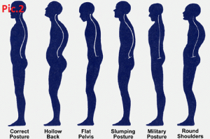Сurvature of posture